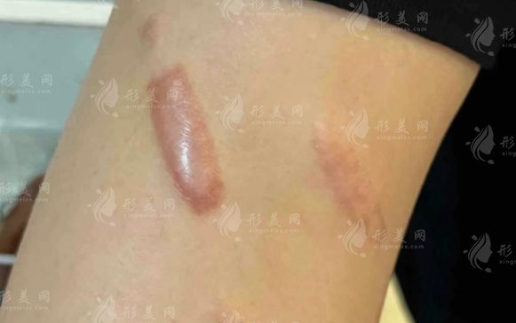 脸上1cm疤痕修复多少钱?激光祛疤vs手术切疤价格对比表 脸上1cm疤痕修复多少钱?激光祛疤vs手术切疤价格对比表