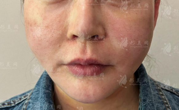 馒化脸放任不管会更严重吗?一文讲清修复与预防