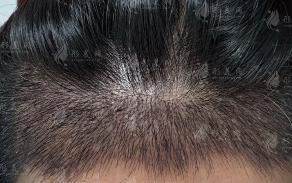 南宁贞韩植发2000单位多少钱 避坑指南 + 价格表