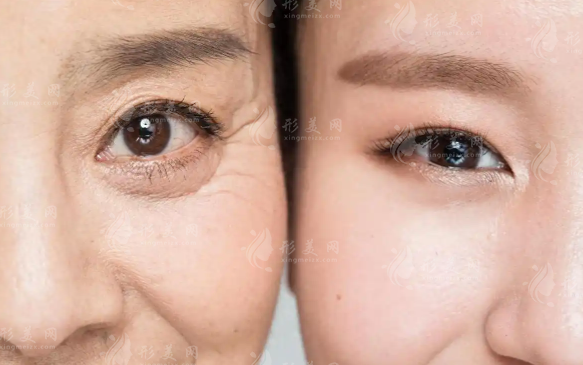 润致5号玻尿酸会加速衰老?真相揭秘：大分子才是抗衰利器