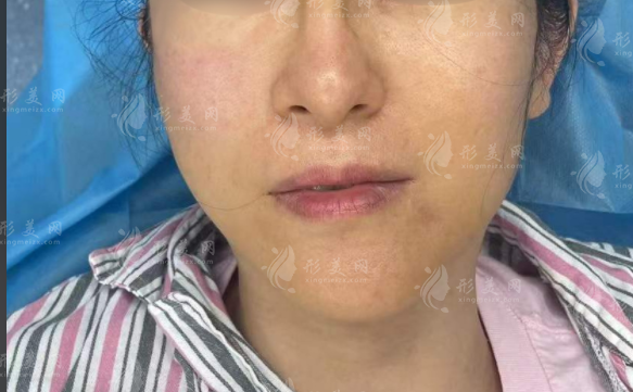 上海王洪医生靠谱吗?生长因子奥美定修复技术全揭秘