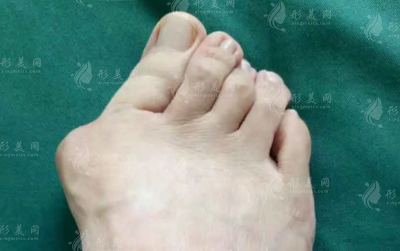 温建民微创治大脚骨靠谱吗？术后效果与费用详解