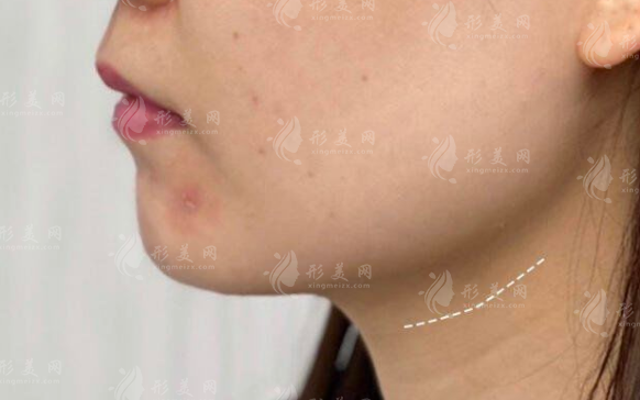 武汉下颌缘提升哪家好？3家医院轮廓针实测对比