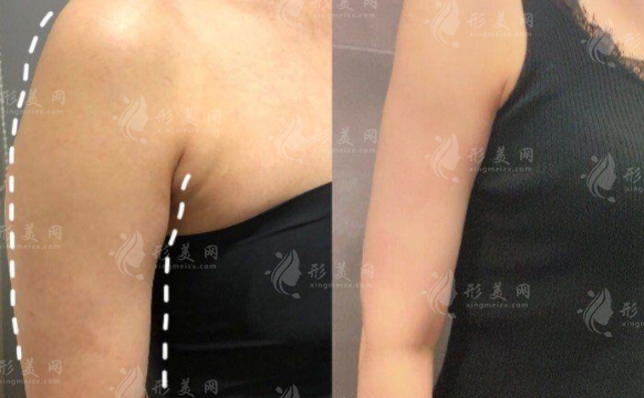 西安吸脂医院哪家好?7家正规医院技术实力盘点