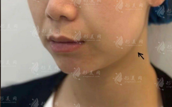 下颌线和下颚线分不清？侧脸清晰的秘密全在这