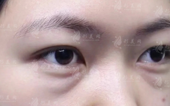 郑州健丽不开刀去眼袋靠谱吗？技术价格人群全解析