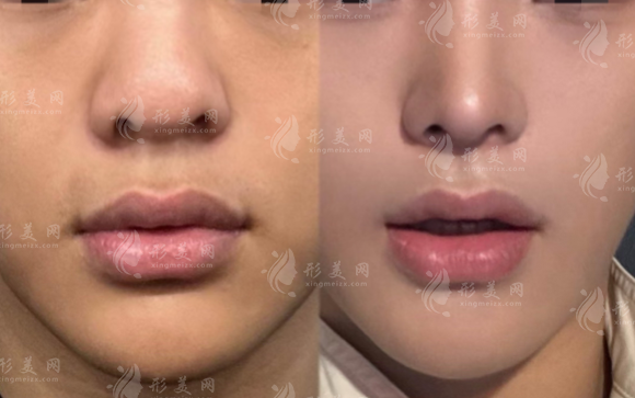 朱刚强鼻整形技术怎么样？20年经验医生实力揭秘