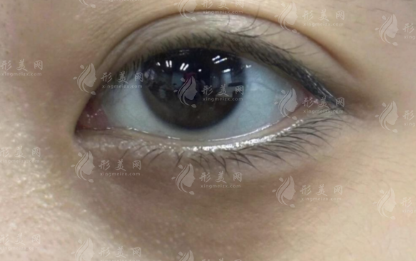 玻尿酸去黑眼圈有效吗？原理、维持时间和价格解析