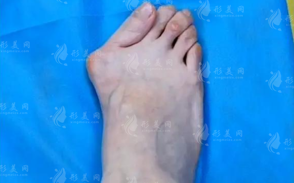 2026苏敬达微创大脚骨价格曝光，北京圣嘉新亲诊预约攻略