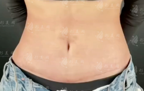 成都腹壁整形选谁好?刘亚平vs李献和技术口碑大比拼