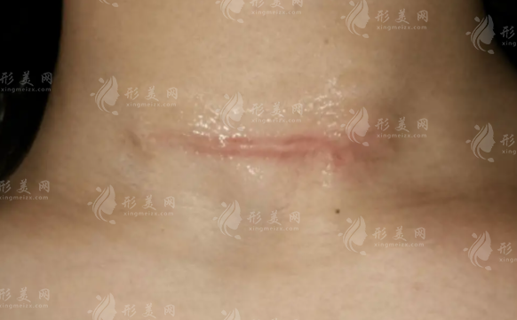 广州祛疤医院哪家好?排名前五正规医院医生名单出炉