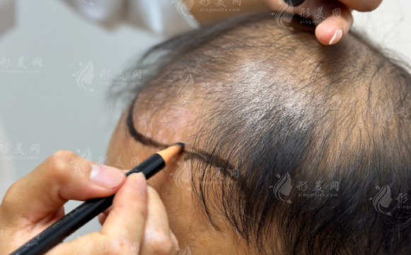 广州植发医院哪家好?排名前十名单+医生推荐+价格表