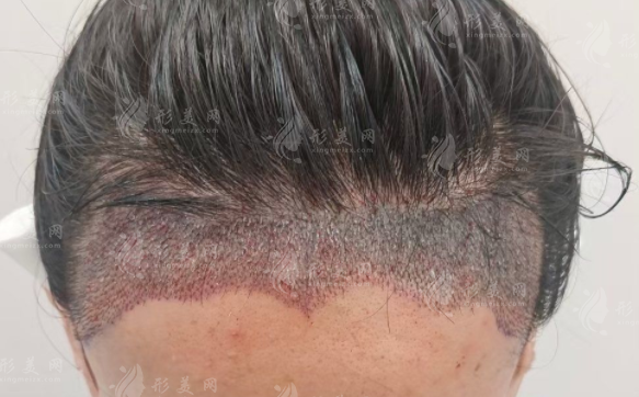 广州植发医院哪家好?这三家技术靠谱口碑公认