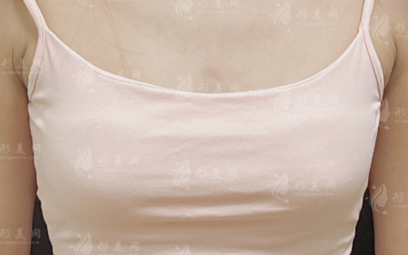 打了20年的丰胸针现在慌不慌?这3个隐患比癌变更吓人