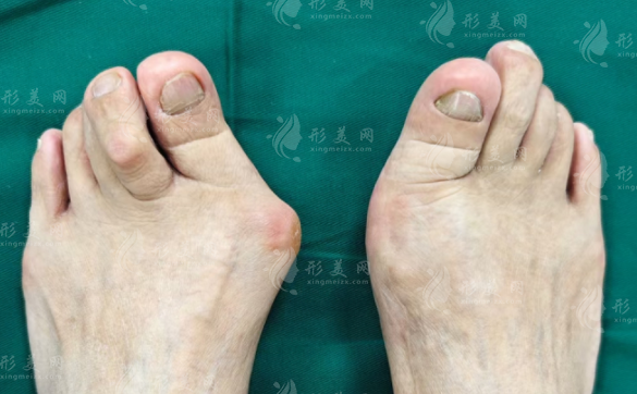 苏敬达做拇外翻手术靠谱吗?技术、费用、适合人群全扒皮