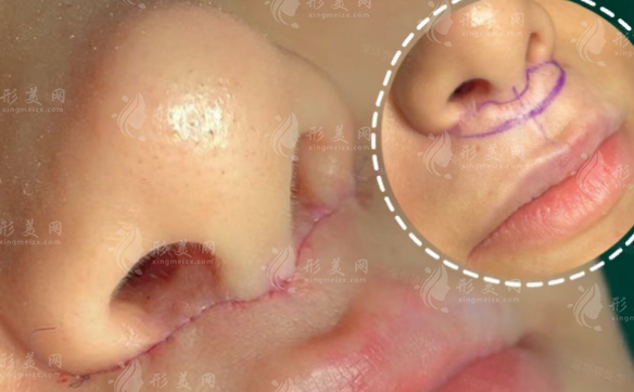 人中太长显老气?无痕人中缩短术真能不留疤?
