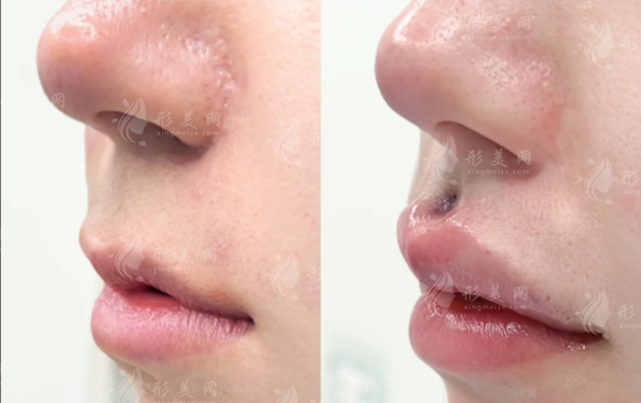 人中太长显老气?无痕人中缩短术真能不留疤?