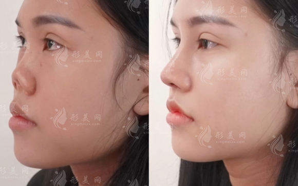 武汉亚韩做鼻子靠谱吗?地址、技术、价格全扒皮!