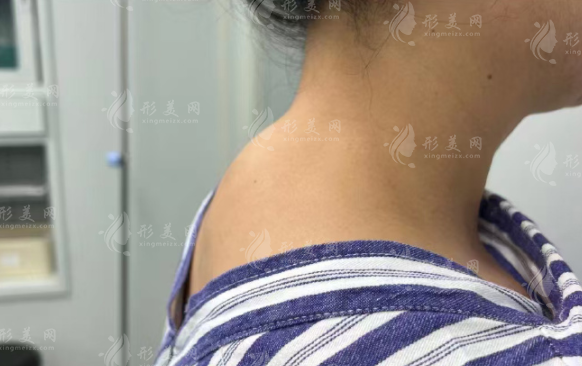 西安富贵包消除哪家强?6大医院技术+医生+价格全PK!