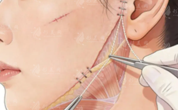 小切口拉皮几岁能做?效果维持多久价格贵吗