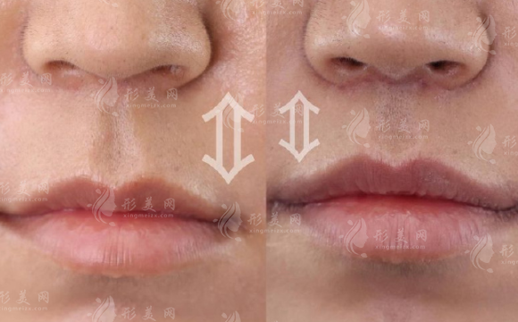 郑州池凯做人中缩短咋样?M唇技术细节大公开