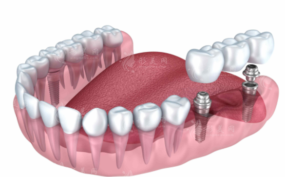 种植牙选ABT还是Zimmer?两大高端品牌对比攻略