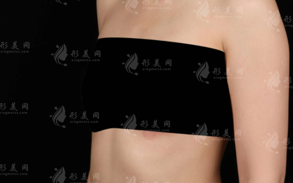 20年前注射隆胸或是"定时炸弹"，奥美定/英捷尔法勒取出刻不容缓