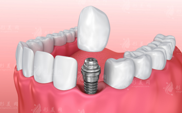 2026年中老年种牙费用全解析：单颗半口全口价格一览表