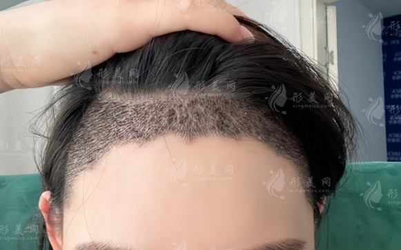 2026广州曙光植发价目表：发际线头顶加密眉毛种植费用全览