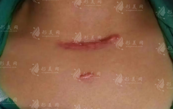 重庆祛疤医院哪家好？军科华美疤痕科口碑技术双在线