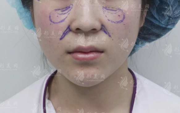 成都脂肪填充哪家好?怡脂整形局麻不住院自然变美攻略