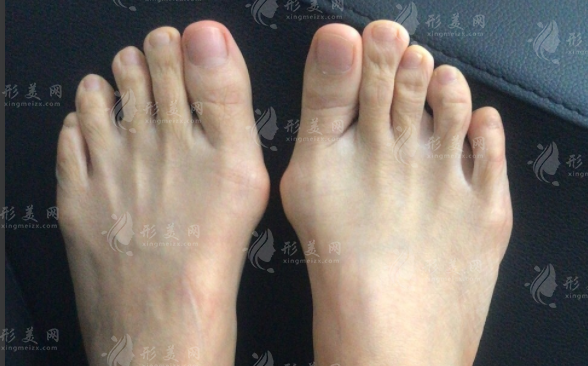 拇外翻必须手术吗?大脚骨治疗方式选择全攻略