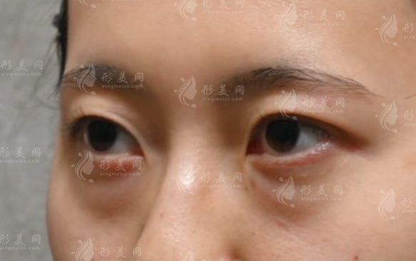 广州曙光去眼袋6200元起，不开刀术式靠谱吗?价格差异真相揭秘