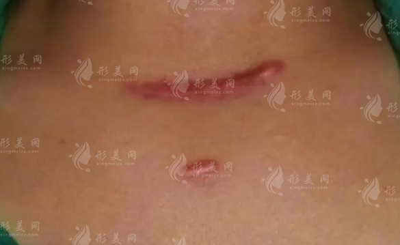 国内疤痕修复医院哪家好?10家正规祛疤机构地址价格全攻略 