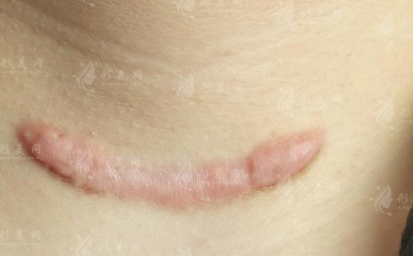 深圳祛疤医院哪家好？这3家技术硬核价格透明，疤痕党必看！