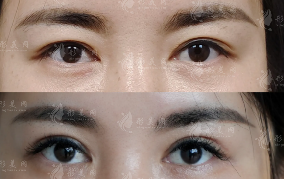 武汉眼修复医生怎么选?王海平与项利姣技术对比+费用揭秘!