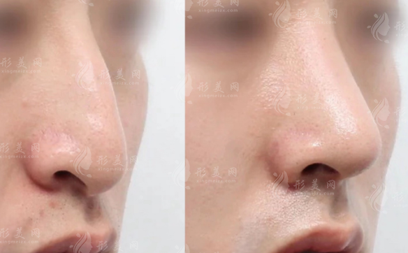西安房志强隆鼻技术好吗?初鼻/鼻修复双料专家实力揭秘!