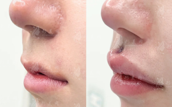 重庆李泽人中缩短有疤痕吗?技术/价格/避坑指南全解析!