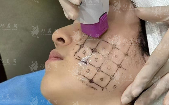 北京热玛吉正规医院排名!嘉禾/艺星/联合丽格技术口碑双在线