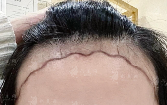 沈阳华美植发医院地址+价格!PNP微针10元/毛囊可约刘凯 沈阳华美植发医院地址+价格!PNP微针10元/毛囊可约刘凯