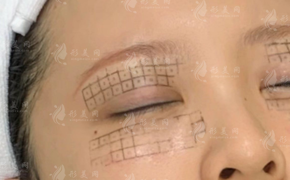 眼部热玛吉效果实测!细纹眼袋黑眼圈能改善吗 眼部热玛吉效果实测!细纹眼袋黑眼圈能改善吗