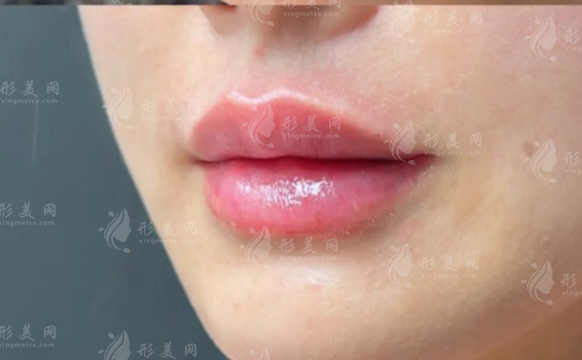 40岁丰唇避坑指南!玻尿酸嘟嘟唇五大禁忌必看
