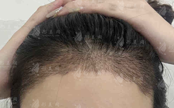福州海峡植发医院2026价格揭秘!微针1000单位2980起，不剃发4999起