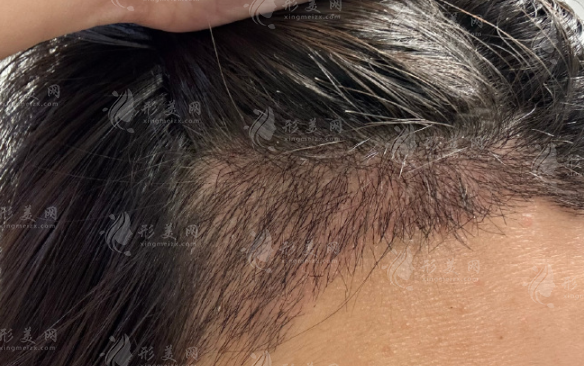 福州植发医生陈俊义怎么样?不剃发植发技术口碑好价格透明