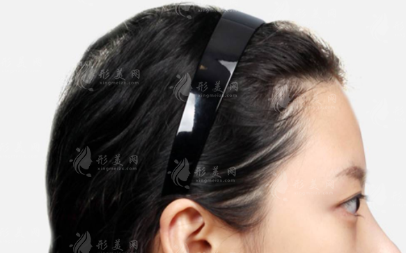 骨水泥颅顶填充术多少钱?手术全过程及价格表一览