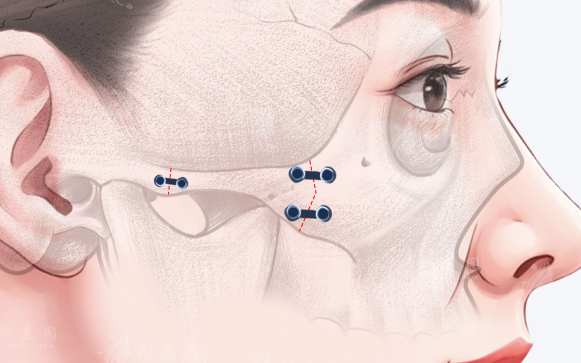 广州磨骨医院哪家好?这2家削骨手术口碑技术双在线