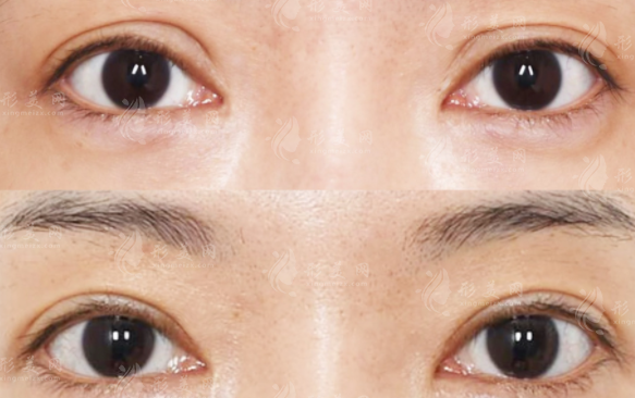 刘志刚双眼皮修复怎么样?假宽深眼修复技术解析