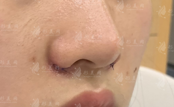 深圳鼻翼缩小医院哪家好？四大口碑机构实力PK