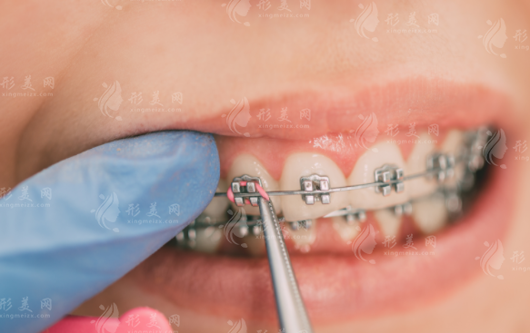 深圳正恩口腔矫正靠谱吗？陈旭医生正畸技术深度解析