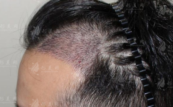 沈阳华美植发医院靠谱吗？技术实力与价格明细全公开